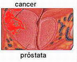 Sexo, masturbación y... cáncer de próstata